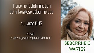 Traitement délimination de la kératose séborrhéique à Laval et dans la grande région de Montréal [upl. by Cindie15]