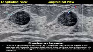 Fibroadenoma Breast Ultrasound Report Example  Benign Tumors USG Scan Report Findings amp Impression [upl. by Armington263]