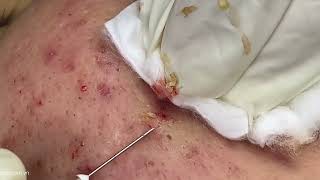 Big Cystic Acne Blackheads Extraction Blackheads amp Milia Whiteheads Removal Pimple Popping [upl. by Jankell]