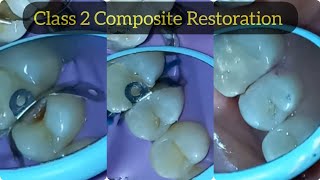 Composite Restoration of Class 2 Cavity in Upper Premolar  Posterior Composite Filling [upl. by Whitaker]