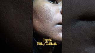 Day27 Using Tretinoin 0025 cream viralvideo tretinoin tretinoincream shorts youtubeshorts [upl. by Suoivatco]