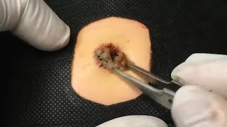 BEST Pimple Popping  Whiteheads Removal  Big Cystic Acne Blackheads  Squeezing Pimples  Tr0039 [upl. by Aubarta434]