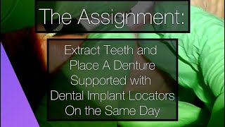 Selective Extractions and Implant Placement for Locator Attachments [upl. by Shiverick755]