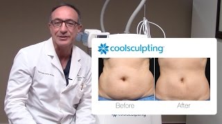 CoolSculpting Procedure Before and After with Dr Lista  The Plastic Surgery Clinic [upl. by Llerehs]