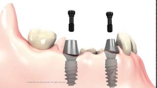 3 unit Bridge on implant abutments [upl. by Lette]