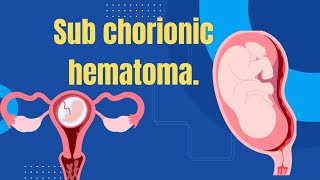 Sub chorionic hematoma Dr Sireesha [upl. by Tongue]