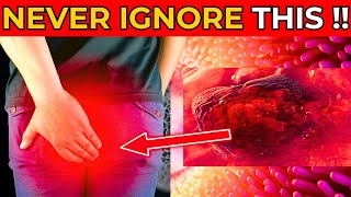 Early SIGNS of COLON CANCER you MUST NOT IGNORE [upl. by Lareneg821]