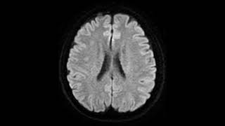 Neuroradiology Acute Bilateral Fornix Infarction from radiopedia case radiology neuroradiology [upl. by Enitselec]