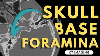 Skull Base Foramina  Radiology anatomy part 1 prep  CT imaging of skull base [upl. by Averell373]