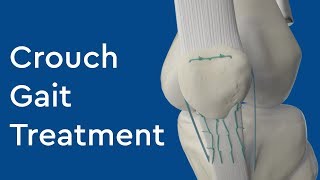 What is Crouch Gait Treatment [upl. by Shandeigh]