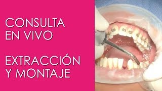 EXTRACCIÓN DENTAL  DIENTE FANTASMA SACANDO UN DIENTE EN VIVO [upl. by Llednor]