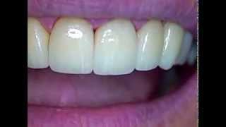 4 DR GERARD CUOMO 34 Porcelain Veneer Crown Restoration Deep Overbite Case [upl. by Imnubulo286]