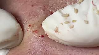 Acne Treatment Huong Da Nang  2024 blackheads 707 [upl. by Carlick]