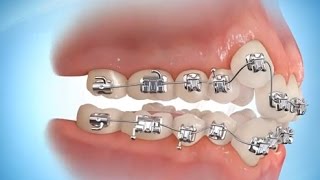 TEL TAKTIRMA  Adding BracesampDental Crown Placement [upl. by Aztilay]