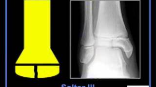 LearningRadiology 06 SalterHarris Classification [upl. by Groscr139]