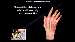 Rheumatoid Arthritis Of The Hand  Everything You Need To Know  Dr Nabil Ebraheim [upl. by Ennylhsa]