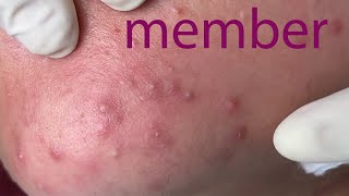 Acne Treatment Huong Da Nang membership 013   2023 [upl. by Atla]