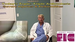 What Is A Triple Arthrodesis Can It Help Stop My Foot Pain [upl. by Yekcim]