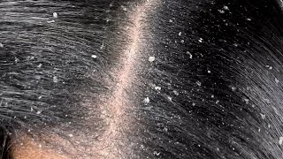 ASMR Dandruff scratchingDandruffPsoriasScalp [upl. by Nnayram134]