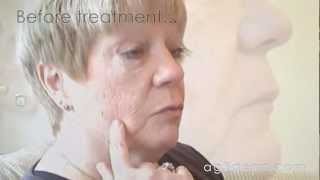 Ann Ag3derm  Age Spot amp Keratosis [upl. by Rillis]