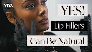 Natural Lip Filler Procedure 👄 Before amp After of Subtle and Delicate Lip Modification [upl. by Swords]