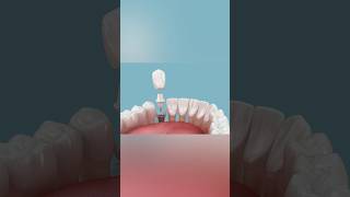 Dental implant installation and crown placement dentist medicalanimation [upl. by Benedic]