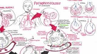 Emphysema  Pathophysiology COPD [upl. by Hermione]