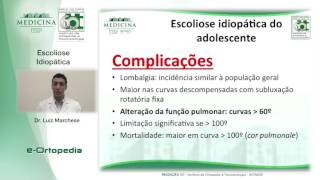 Escoliose Idiopatica  Dr Luiz Marchese [upl. by Simonsen56]