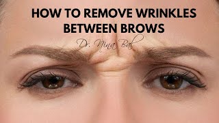 How To Get Rid Of Wrinkles Between Eyebrows 💕 Dr Nina Bal Glabellar Lines Removal [upl. by Kattie]