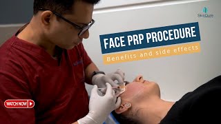 Face PRP Procedure  Benefits and side effects  SkinQure [upl. by Yalcrab]