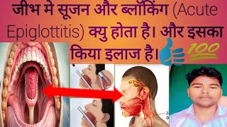 जीभ मे सूजन और ब्लाॅकिंग Acute Epiglottitis क्यु होता है। और इसका किया इलाज है। epiglottiris [upl. by Drewett449]