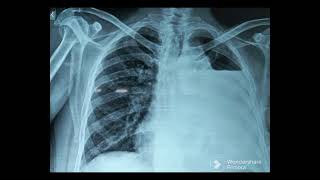 Hydropneumothorax Chest X Ray [upl. by Nevaeh]