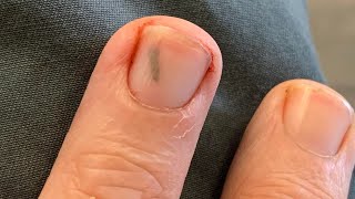 how to get rid of a deep splinter in your finger [upl. by Nacim]