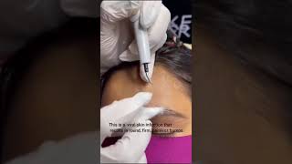 MOLLUSCUM CONTAGIOSUM REMOVAL by Dd Ayesha Faizan mollusca nagpurdermatologist [upl. by Yra]