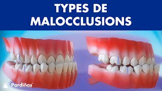 Malocclusion – Types de malocclusions dentaires © [upl. by Atteiram]