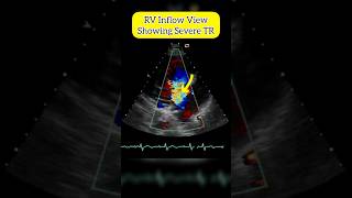 Tricuspid Regurgitation on RV Inflow view of Heart ♥ echocardiography [upl. by Gabriela903]