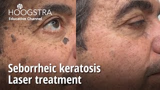 Seborrheic keratosis  Laser treatment  22341 [upl. by Lazare331]