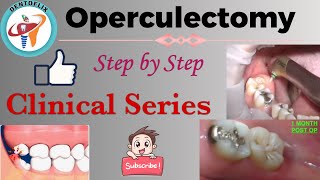 Operculectomy  Step by Step  Clinical Series [upl. by Wilson]