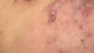 Inflammatory Acne Treatment [upl. by Airamahs]