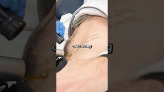 Scarring after Laser Tattoo Removal  tattooremoval tattooed skincare [upl. by Farnham]