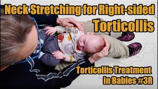 3R Neck Stretching for Rightsided Torticollis Torticollis Treatment in Babies [upl. by Ecnaled]