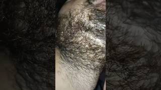 beard hair longer Carly problem beard hairproblem barber barbershop ingrownhair hairremoval [upl. by Kassab]