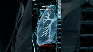 Expiratory Wheezing is an abnormal lungs sound adventitious sound shorts [upl. by Wernsman540]