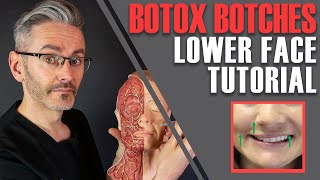 ADVANCED BOTOX ANATOMY How to avoid nasty lowerface side effects Aesthetics Mastery Show [upl. by Damahom]