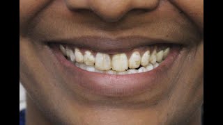 Do you hide your teeth due to Fluorosis Find out the best treatmentVideo by Dr Trivikram [upl. by Idnew]