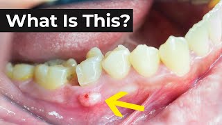 What is an Abscessed Tooth amp What To Do About It [upl. by Flanagan388]