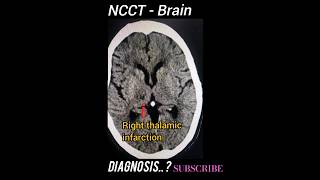 Thalamic Stroke  NCCT Brain  Diagnosis  Practical case [upl. by Karissa145]