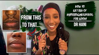 How To Get Rid Of Hyperpigmentation  Dr Hani [upl. by Nylanej4]