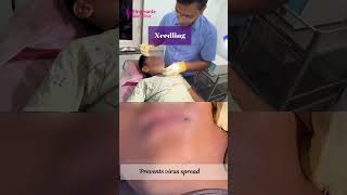 quotSay Goodbye to Molluscum Contagiosum Effective Treatments at Singhania Skin Clinic [upl. by Llerraf]