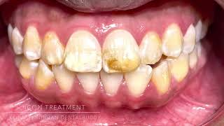 Icon treatment Fluorosis [upl. by Kimon378]